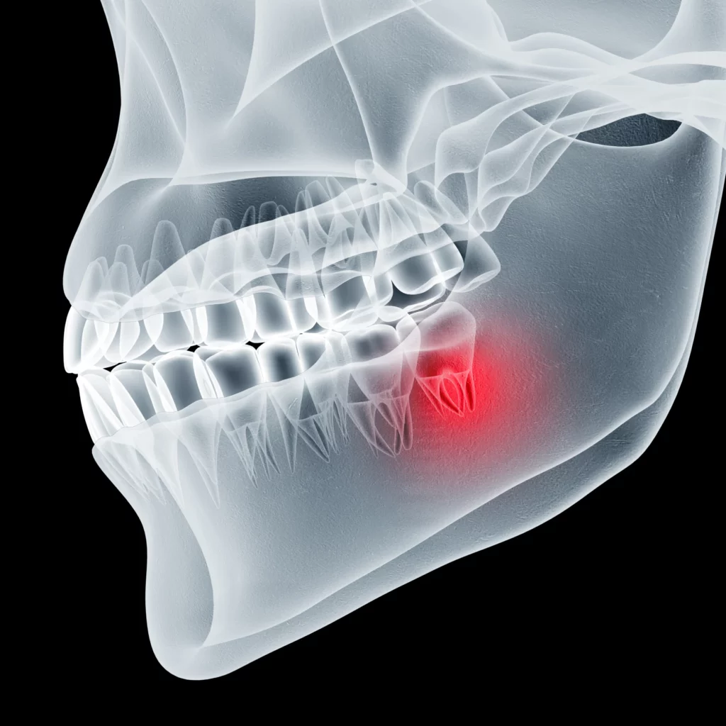 wisdom teeth removal in Spokane Valley, WA