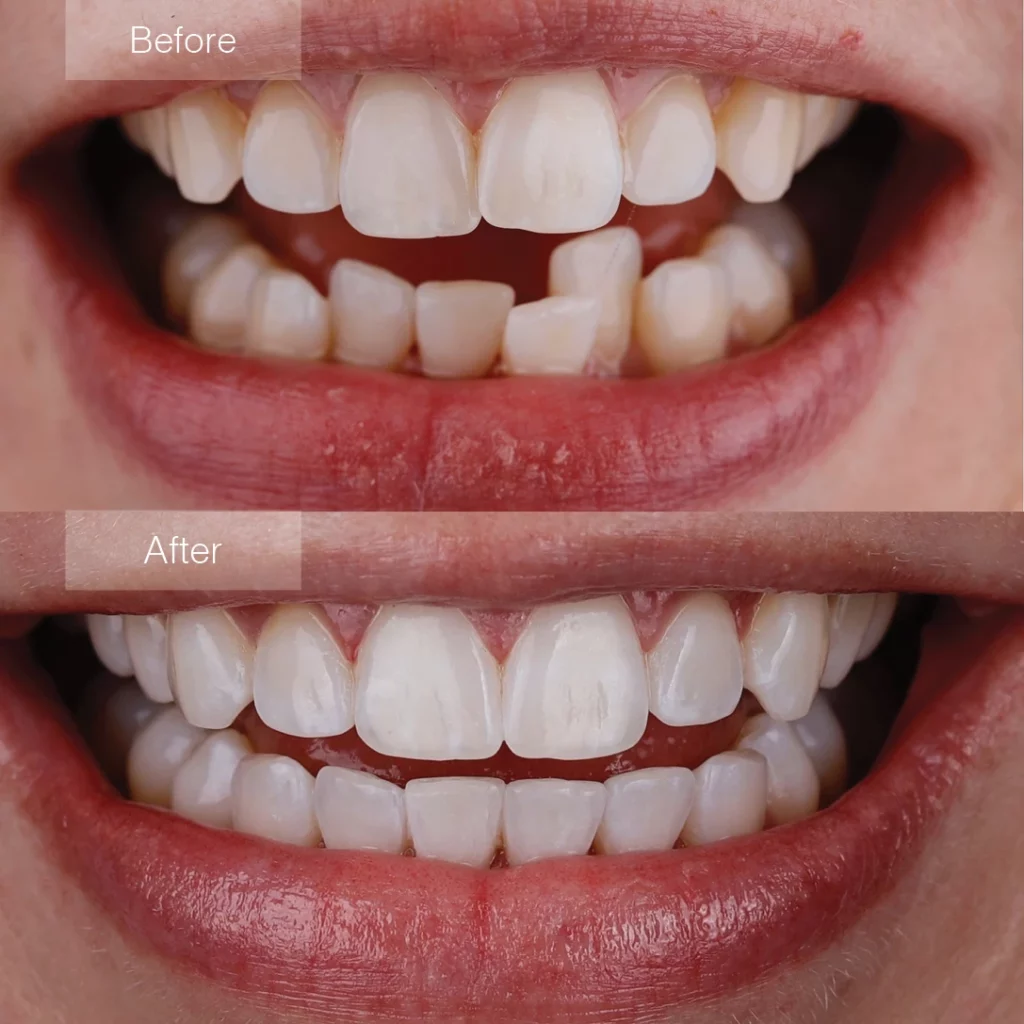 before and after clear aligner treatment