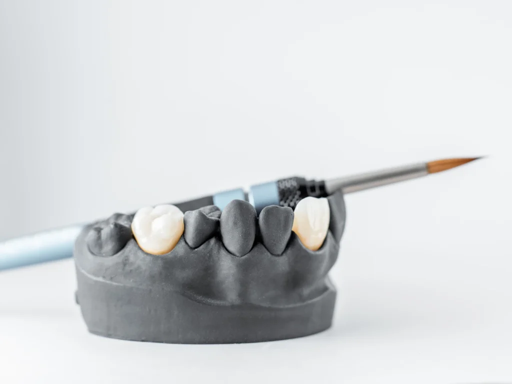 jaw model showing porcelain same-day dental crowns